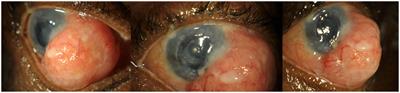 Case report: Primary infection of conjunctival histoplasmosis mimicking a large conjunctival neoplasm in an immunosuppressed patient